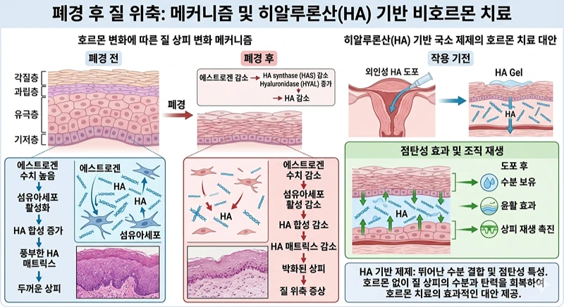 성의학적으로 살펴보는 질건조증 원인과 히알루론산(HA) 비호르몬 치료 폐경 전후 여성호르몬 감소에 따른 질 상피 위축 메커니즘과 히알루론산을 이용한 질건조증 비호르몬 치료 원리 설명 인포그래픽